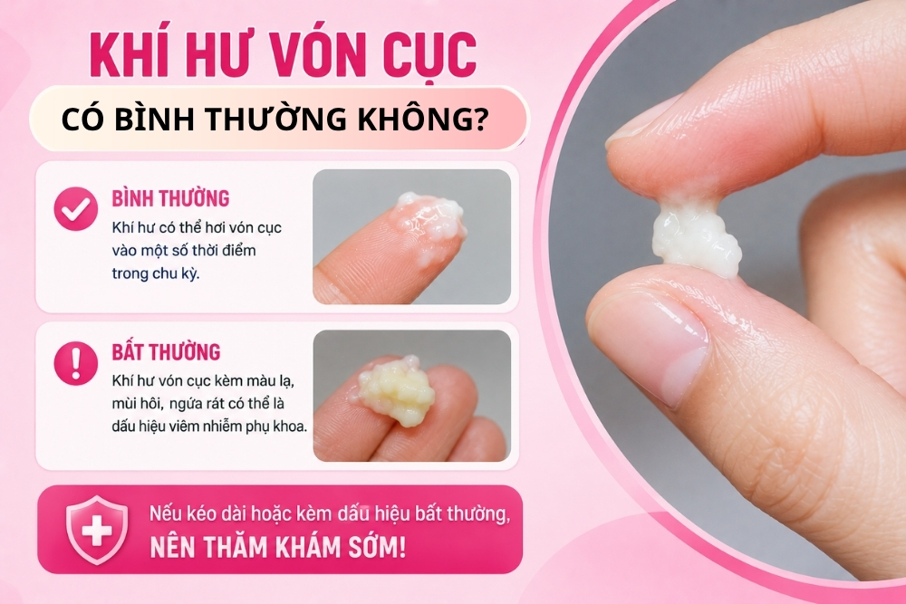 Khí Hư Vón Cục Là Dấu Hiệu Bệnh Gì? Nguyên Nhân Và Cách Điều Trị