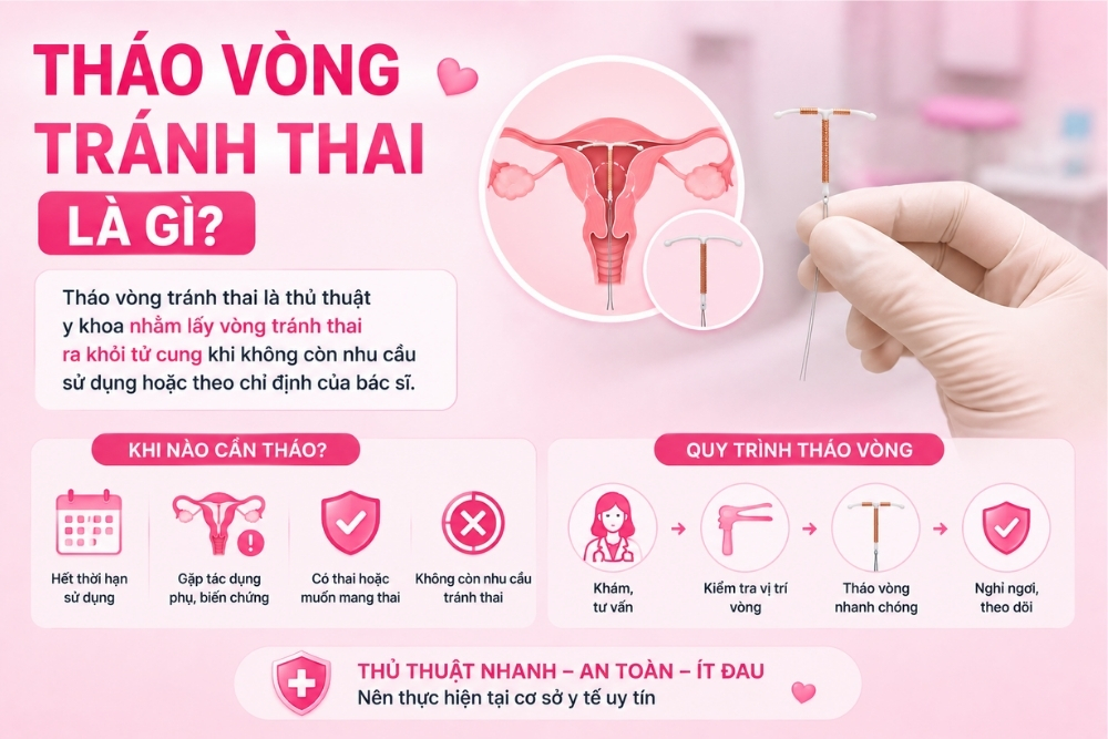 Tháo Vòng Tránh Thai: Tư Vấn Và Thực Hiện An Toàn Cho Phụ Nữ